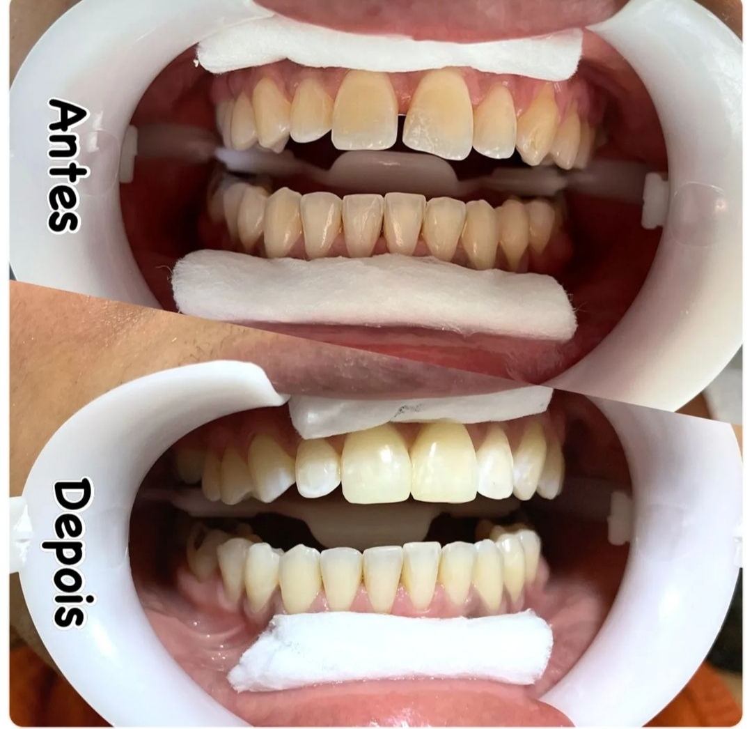 Clareamento Dental e Facetas em Resina